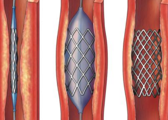 好消息！700元冠脈支架來了帶量采購結(jié)果在甘肅省正式落地執(zhí)行
